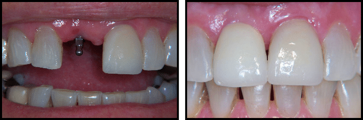 Dental implant before & After