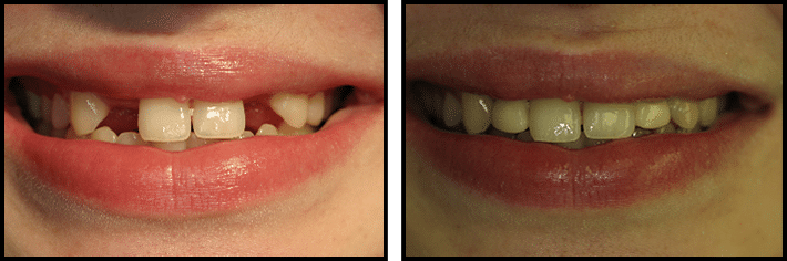Dental implant before & After