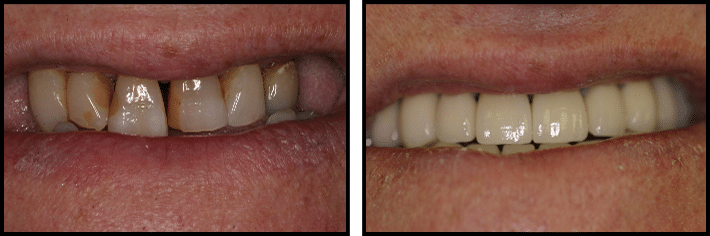 Dental implants before & After