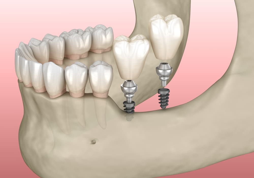 Implantation with mini implants in to recessed jaw bone
