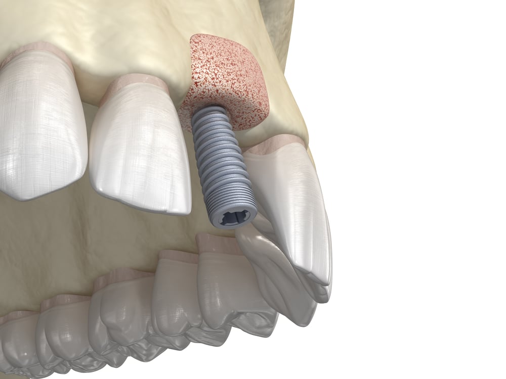 Bone grafting- augmentation using ring method, tooth implantation.