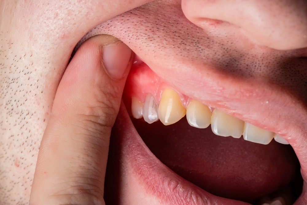 Red and swollen gums in a man. Gum disease gingivitis, flux and inflammation